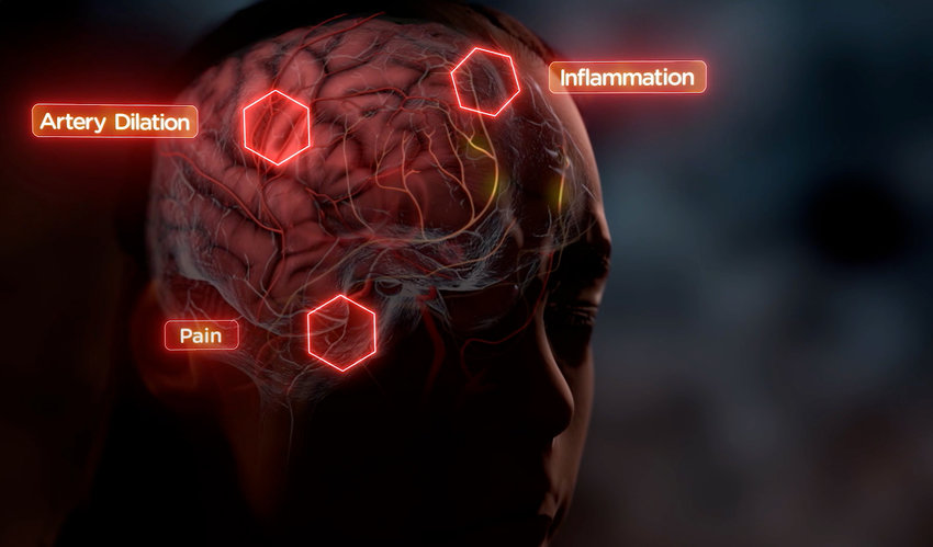 Migraine brain image by Biohaven Pharmaceuticals