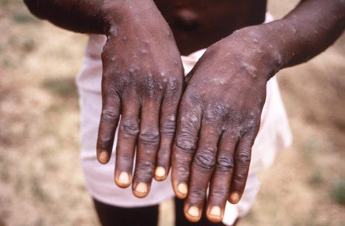 An image in 1997 was taken during an investigation into an outbreak of monkeypox, which took place in the Democratic Republic of the Congo (DRC). The virus has now expanded globally.