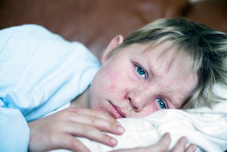 Young children, pregnant people, and the immunocompromised are among the most vulnerable to measles.