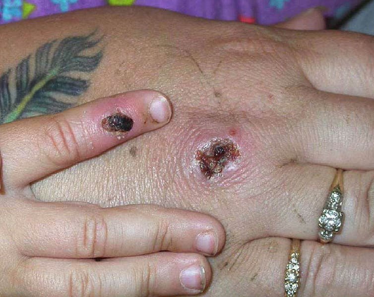 Monkeypox causes lesions that resemble pus-filled blisters, which eventually scab over.