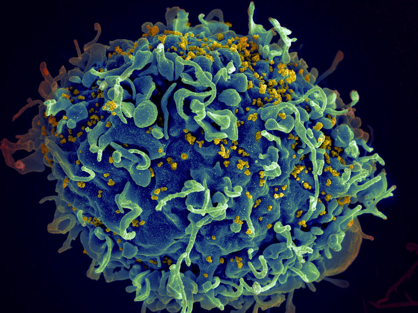 This electron microscope image made available by the U.S. National Institutes of Health shows a human T cell, in blue, under attack by HIV, in yellow, the virus that causes AIDS. (NIH via AP, File)