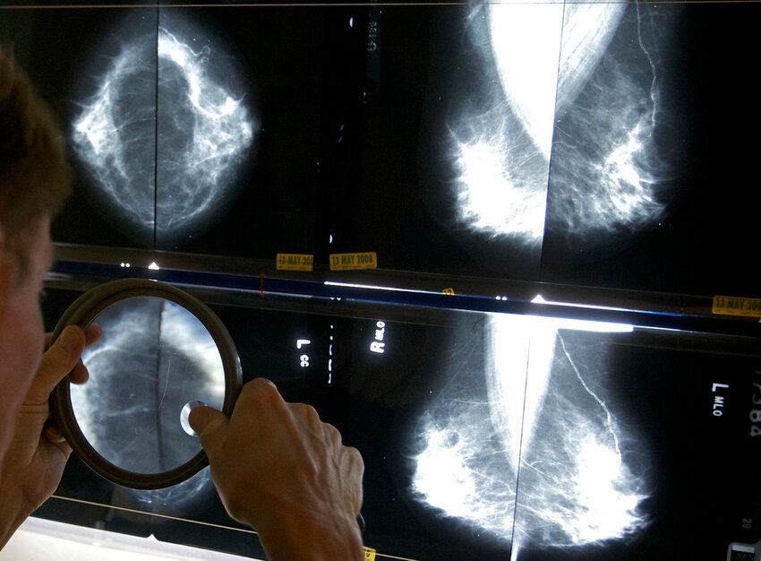A radiologist uses a magnifying glass to check mammograms for breast cancer in Los Angeles, May 6, 2010. (AP Photo/Damian Dovarganes, File)