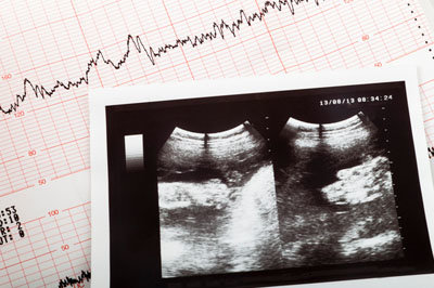 Baby cardiogram GETTY IMAGES
