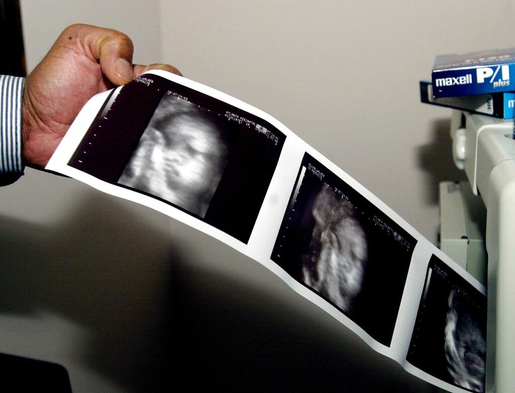 A doctor looks at a printout from a 3-D Sonogram in Jonesboro, Ga. “The department will recognize any unborn child with a detectable human heartbeat … as eligible for the Georgia individual income tax dependent exemption,” the Georgia Department of Revenue said in a news release. (AP Photo/Ric Feld, File)