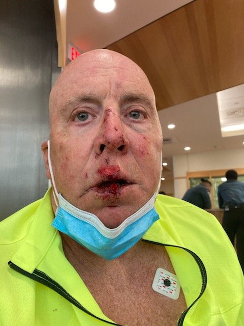 Mich Myette wound up with a severely broken jaw after a collision with another cyclist on the East Bay Bike Path near Bridge Street in Warren. The man who hit him has not been identified after giving a fake name and address to police.