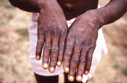 FILE - This 1997 image provided by the CDC during an investigation into an outbreak of monkeypox, which took place in the Democratic Republic of the Congo (DRC), formerly Zaire, and depicts the dorsal surfaces of the hands of a monkeypox case patient, who was displaying the appearance of the characteristic rash during its recuperative stage. Health authorities in Africa said Thursday, June 30, 2022 they are treating the expanding monkeypox outbreak there as an emergency and are calling on rich countries to share the world's limited supply of vaccines in an effort to avoid the glaring equity problems seen during the COVID-19 pandemic. (CDC via AP, File)