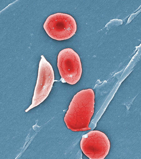 FILE - This 2009 colorized microscope image made available by the Sickle Cell Foundation of Georgia via the Centers for Disease Control and Prevention shows a sickle cell, left, and normal red blood cells of a patient with sickle cell anemia. A study of U.S. children with sickle cell disease found fewer than half get a needed screening for stroke, a common complication. And only about half or fewer get a treatment that can help with pain and anemia, the study found. The Centers for Disease Control and Prevention released the study Tuesday, Sept. 20, 2022, and called for more screening and treatment. (Janice Haney Carr/CDC/Sickle Cell Foundation of Georgia via AP, File)
